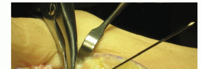 Illustration 17 for Plantar Plate Repair: End Lesser Toe Pain & Instability