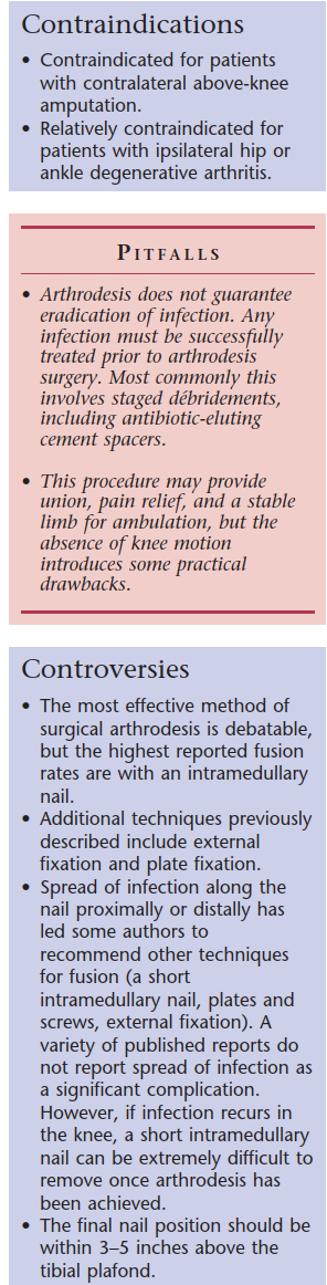 Intramedullary Arthrodesis: Solving Failed Total Knee Arthroplasty