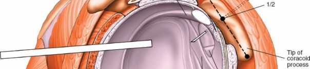 Illustration 223 for Essential Guide: Mastering Every Approach to the Shoulder