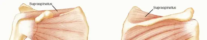 صورة توضيحية لـ وداعاً لخلع الكتف المتكرر: دليل شامل لإصلاح بانكارت وتعديل محفظة الكتف واستعادة حريتك في الحركة