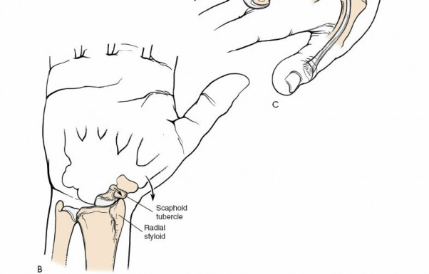Illustration 48 for Dorsal Wrist Approach: Expert Access to the Column of the Distal Radius