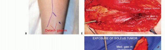 صورة طبية: استئصال ورم العضلة النعلية: دليل شامل لحماية عضلة الساق والتعافي الكامل في صنعاء مع الأستاذ الدكتور محمد هطيف