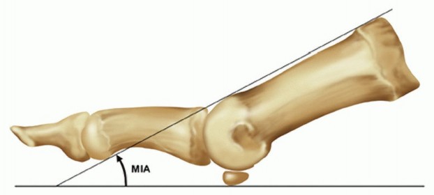 Metatarsophalangeal Joint Arthrodesis: Key Techniques for Success