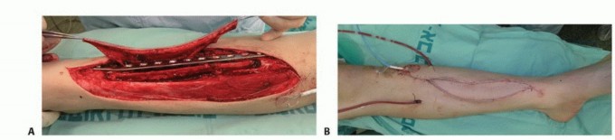 صورة طبية: ترقيع الشظية الوعائي الحر: حلول متقدمة لعيوب العظام المعقدة