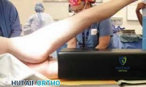 Labral Takedown and Rim Trimming