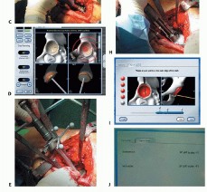 صورة طبية: ترميم مفصل الورك: الحل الأمثل للحفاظ على عظم رأس الفخذ في صنعاء مع الدكتور محمد هطيف