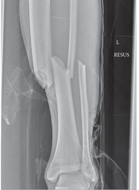 Illustration 2 for High-Energy Midshaft Diaphyseal Tibia Fracture: A Trauma Approach
