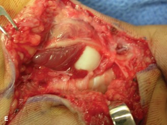 Illustration 2 for Diagnosing Complex Injury: The Joint of the Index Finger