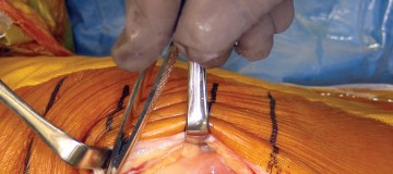 Illustration 9 for Minimize Pain, Maximize Recovery: TKA with Parapatellar