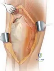 Illustration of exposure vy quadroplasty - Dr. Mohammed Hutaif