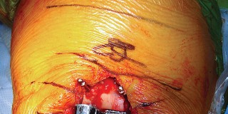 Illustration 45 for Mastering TKA: Essential Methods of Rotational Alignment