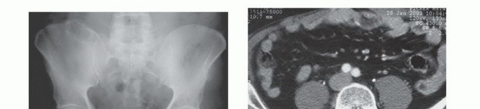 توضيح طبي: جراحة نقائل الحوض: حل شامل لآلام العظام واستعادة الحركة مع الأستاذ الدكتور محمد هطيف