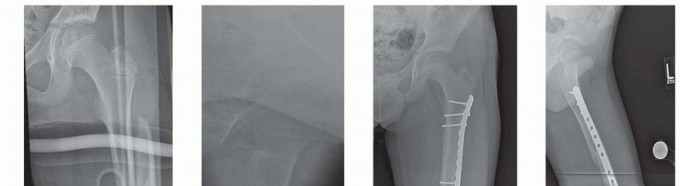 Minimally Invasive Submuscular Plating for Pediatric Femur Fractures
