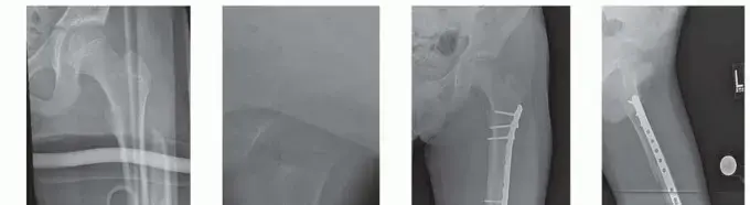 كسور عظم الفخذ عند الأطفال: دليلك الشامل لخيارات العلاج والتعافي مع الأستاذ الدكتور محمد هطيف