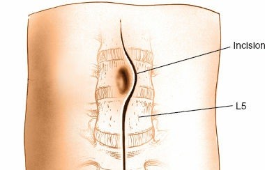 Anterior Retroperitoneal Approach: Step-by-Step for Lumbar Spine Surgery