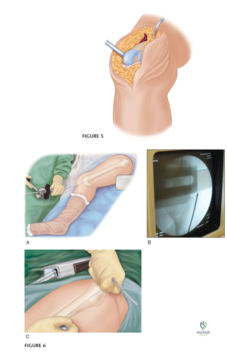 Illustration of total knee arthroplasty - Dr. Mohammed Hutaif