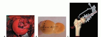 صورة توضيحية لـ ترميم مفصل الورك: الحل الأمثل للحفاظ على عظم رأس الفخذ في صنعاء مع الدكتور محمد هطيف