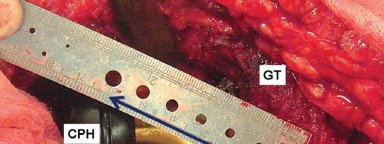 Illustration 12 for Mastering Soft Tissue Balancing for Optimal THR Outcomes