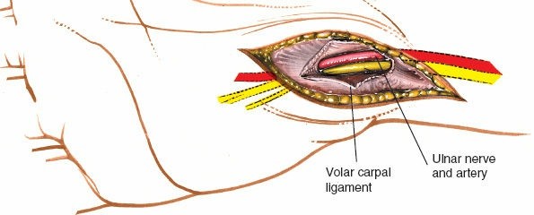 Illustration 91 for Essential Surgical Approaches: Uncover Every Aspect of the Wrist