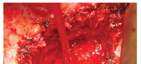 Illustration 5 for Anterior Thoracic Corpectomy: Decompression, Stabilization, Fusion