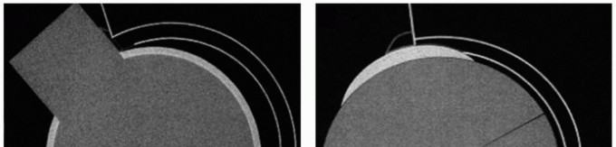 Beyond Knee Surg: Hip Arthroscopy for Sports Injuries