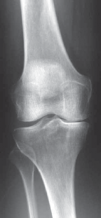 Knee Arthroplasty Unicondylar: Discover if Partial Knee Replacement is Right