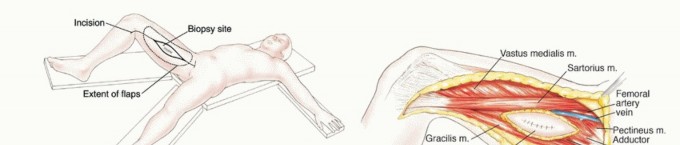 صورة طبية: استئصال أورام العضلات المقربة في الفخذ: الحفاظ على الطرف بتقنيات متقدمة مع الأستاذ الدكتور محمد هطيف في صنعاء