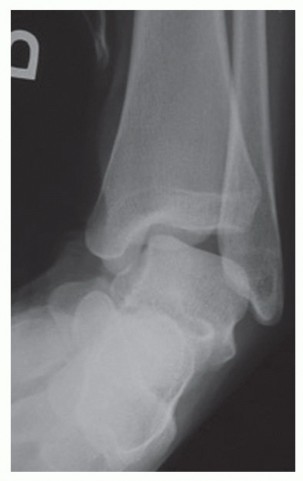 Peroneus Brevis Tendon Tear: Early Repair for Full Recovery