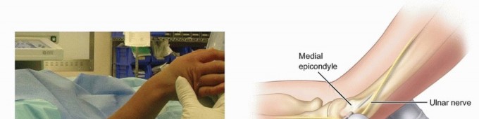 Illustration of pinning of supracondylar - Dr. Mohammed Hutaif