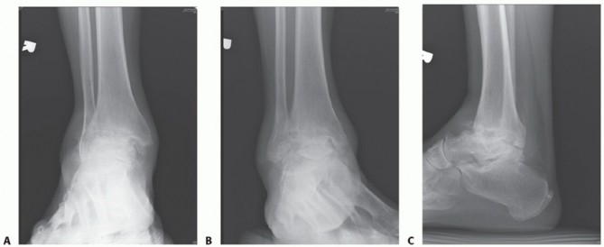 Illustration 40 for Unlock Stability: Medullary Nail Fixation for Tibiotalocalcaneal Arthrodesis