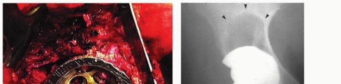 توضيح طبي: هشاشة العظام حول مفصل الورك الاصطناعي تبديل بطانة البولي إيثيلين الحل الأمثل