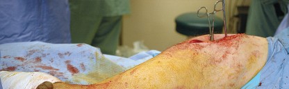 Illustration 55 for Unlock the Figure Posterior Approach to the Hip