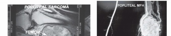 صورة توضيحية لأنواع الأورام والأنسجة الرخوة