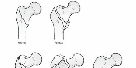 Managing Intertrochanteric Fractures with Unstable Patterns