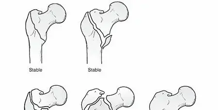صورة توضيحية لـ كسور ما بين المدورين: دليل المريض الشامل للتعافي والحركة مع الأستاذ الدكتور محمد هطيف
