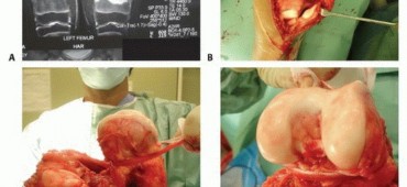 صورة توضيحية لـ الأطراف الصناعية القابلة للتمدد للأطفال: دليل شامل للمرضى حول الوقاية من العدوى والعلاج في صنعاء مع الأستاذ الدكتور محمد هطيف