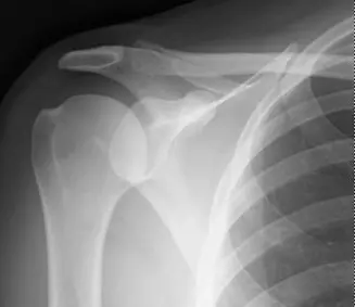 صورة توضيحية لـ إصابات بانكارت وهيل ساكس في الكتف: دليلك الشامل للتشخيص والعلاج والتعافي مع الأستاذ الدكتور محمد هطيف