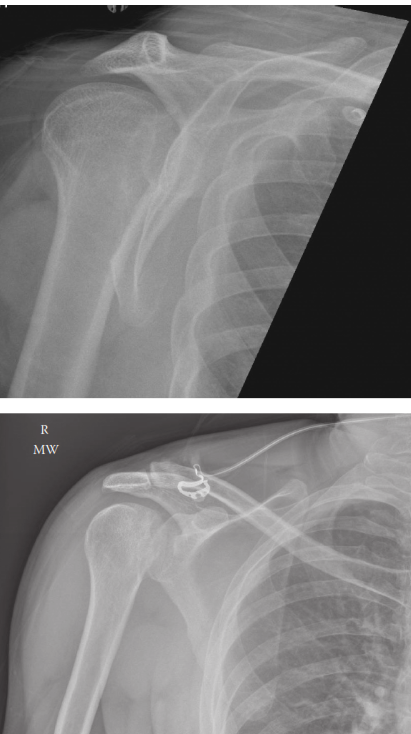 Posterior Dislocation of Shoulder: Lightbulb Sign & Reduction