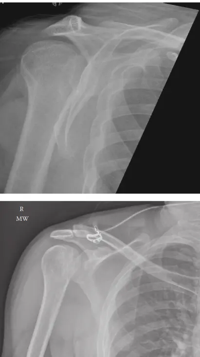 صورة توضيحية لـ الخلع الخلفي لمفصل الكتف: دليل شامل للمرضى من التشخيص إلى التعافي