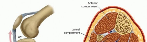 Optimizing Intramedullary Nailing for Tibial Shaft Fractures