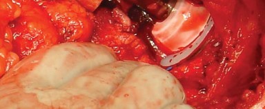 Illustration 27 for Posterolateral Surgical Approaches: Achieve Optimal Hip Replacement