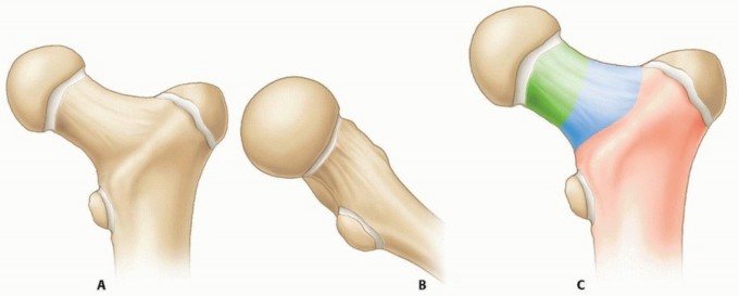 Managing Hip Fractures in Patients Younger Than Years: Key Info