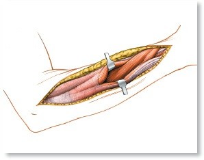 Mastering Approaches to the Upper Third of the Radius