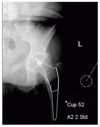 صورة توضيحية لـ ساق الفخذ المدبب: دليل شامل لتثبيت مفصل الورك اللاأسمنتي طويل الأمد مع الأستاذ الدكتور محمد هطيف في صنعاء