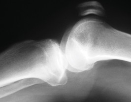 Illustration 81 for Unicompartmental Knee Arthroplasty: Master decisions with this b c figure guide.
