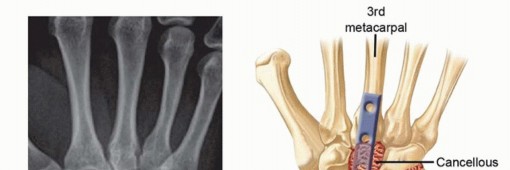  Complete Wrist Arthrodesis