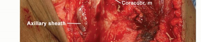 صورة طبية: استئصال أورام الكتف مع الحفاظ على الطرف: أحدث التقنيات لنتائج مثالية مع الأستاذ الدكتور محمد هطيف