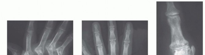 Proximal Interphalangeal and Metacarpophalangeal Joint Silicone Implant Arthroplasty