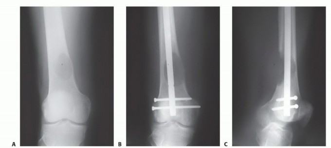 Illustration 13 for Plain Radiograph Showing MBD: Surgical Planning to Prevent Failures