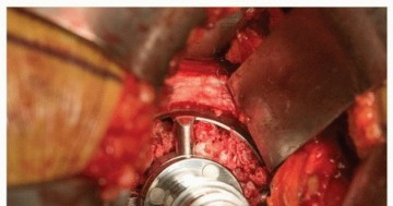 صورة طبية: تثبيت مفصل الورك بدون أسمنت: دليل شامل لمرضى استبدال الورك مع الأستاذ الدكتور محمد هطيف